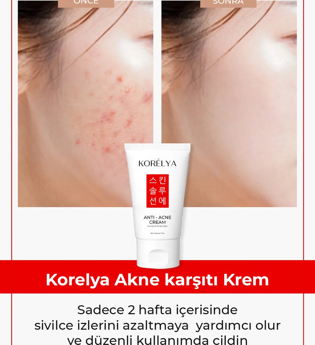 KORELYA Anti Acne Crème 50ml | Koreaanse Skincare | Zeer Gewild & Effectief